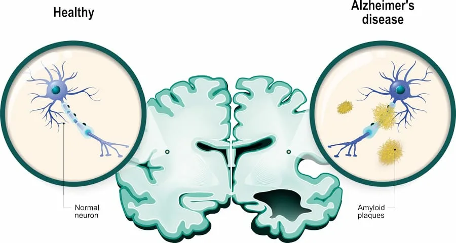 Болезнь Альцгеймера / Alzheimer's disease